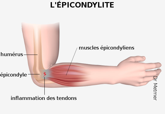 schéma d'une épicondylite avec l'anatomie du coude et l'insertion des tendons